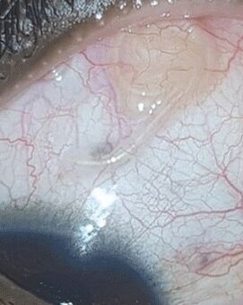 NEOflorax hielp bij het wegwerken van een worm in het oog